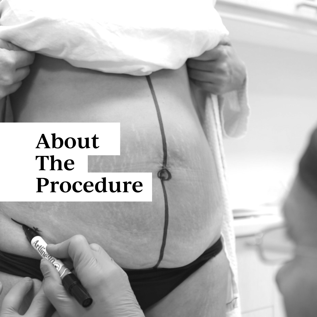 Drainless Day Abdominoplasty (Tummy Tuck) Drainless Day Abdominoplasty (Tummy Tuck)